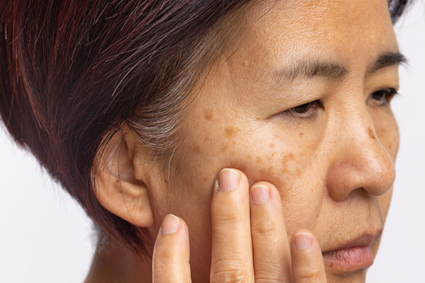 как да премахна кафяви петна по лицето
